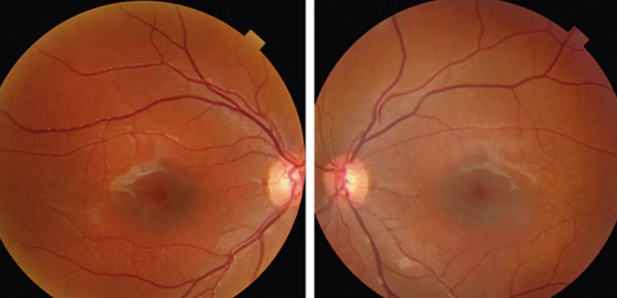 Stargardt’s Disease and Macular Dystrophy Treatment – Approaches to Preserve Vision in Inherited Retinal Disorders
